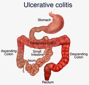 ulcerative-colitis1